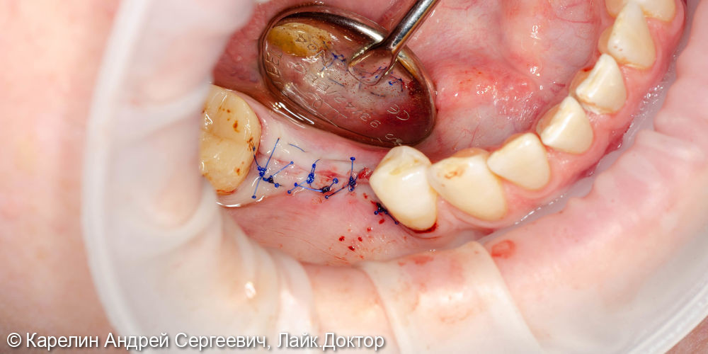 Удаление и имплантация в области зубов 2.4,4.5 и 4.6 - фото №6