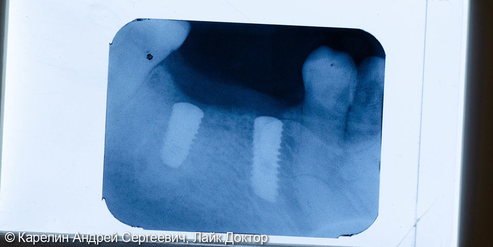 Удаление и имплантация в области зубов 2.4,4.5 и 4.6 - фото №7