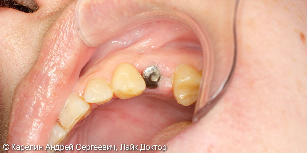 Удаление и имплантация в области зубов 2.4,4.5 и 4.6 - фото №8