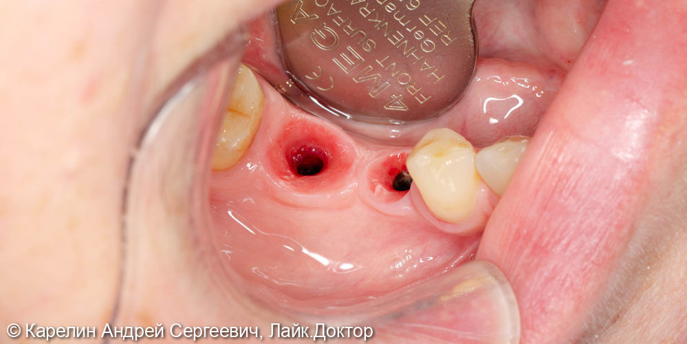 Удаление и имплантация в области зубов 2.4,4.5 и 4.6 - фото №9