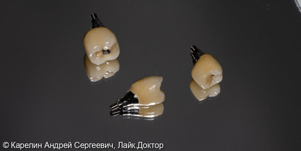 Удаление и имплантация в области зубов 2.4,4.5 и 4.6 - фото №11