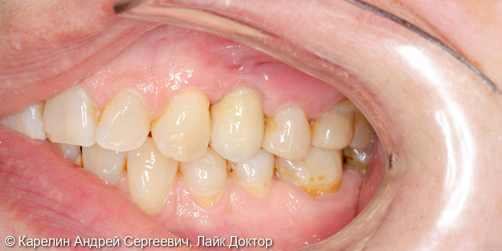 Удаление и имплантация в области зубов 2.4,4.5 и 4.6 - фото №13