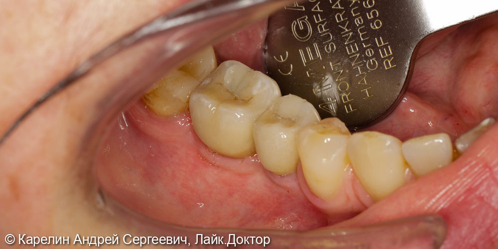 Удаление и имплантация в области зубов 2.4,4.5 и 4.6 - фото №14