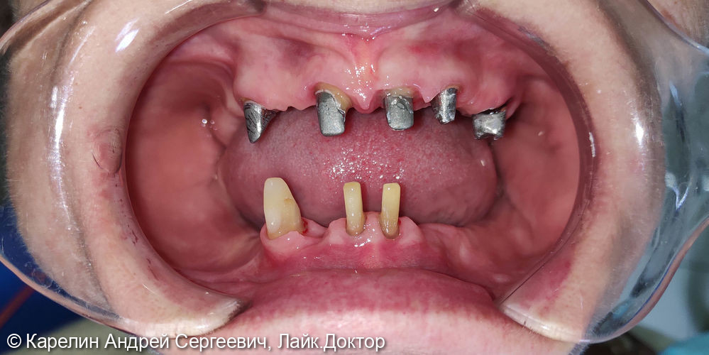 Тотальное протезирование обеих челюстей с помощью металлокерамических коронок и ЧСПП - фото №3