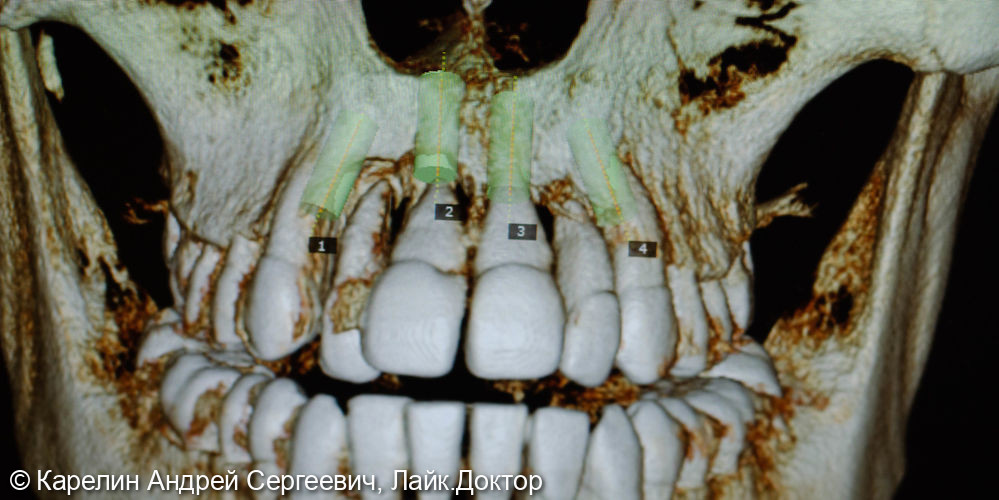 Одномоментная с удалением установка имплантатов во фронтальном участке верхней челюсти - фото №3