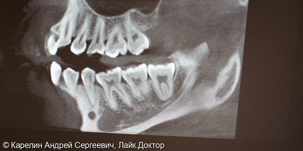 Удаление полупрорезовшегося восьмого зуба на нижней челюсти - фото №1