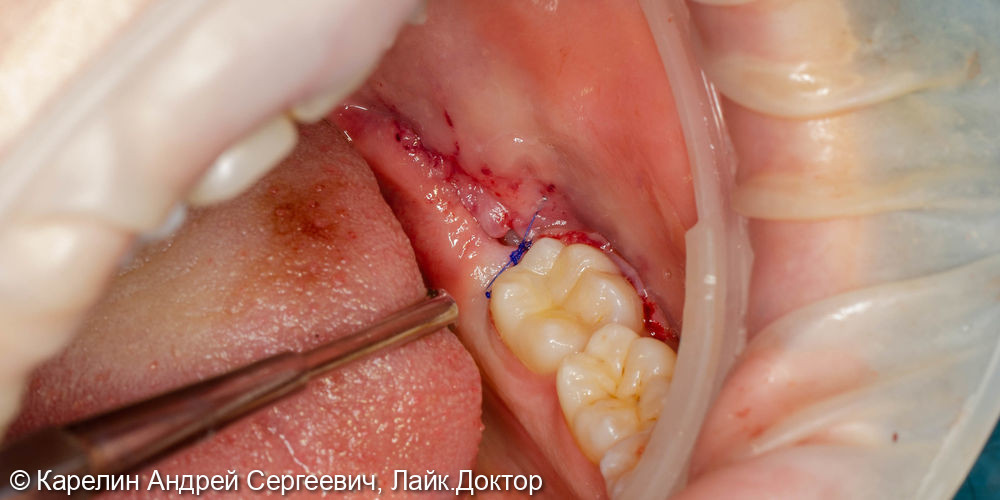 Удаление полупрорезовшегося восьмого зуба на нижней челюсти - фото №4