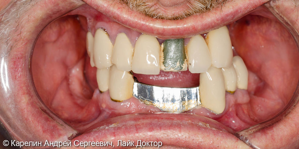 Одномоментное удадение зубов и установка имплантатов - фото №1
