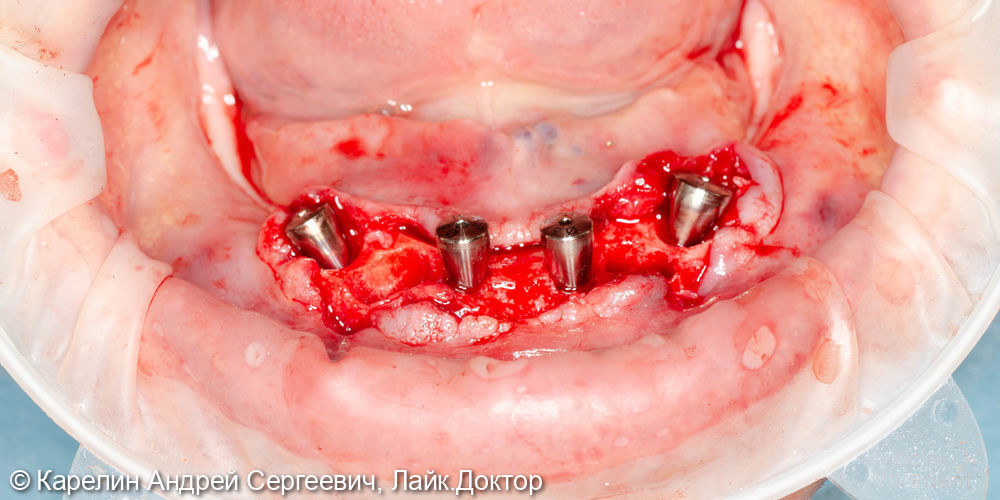 Одномоментное удадение зубов и установка имплантатов - фото №11