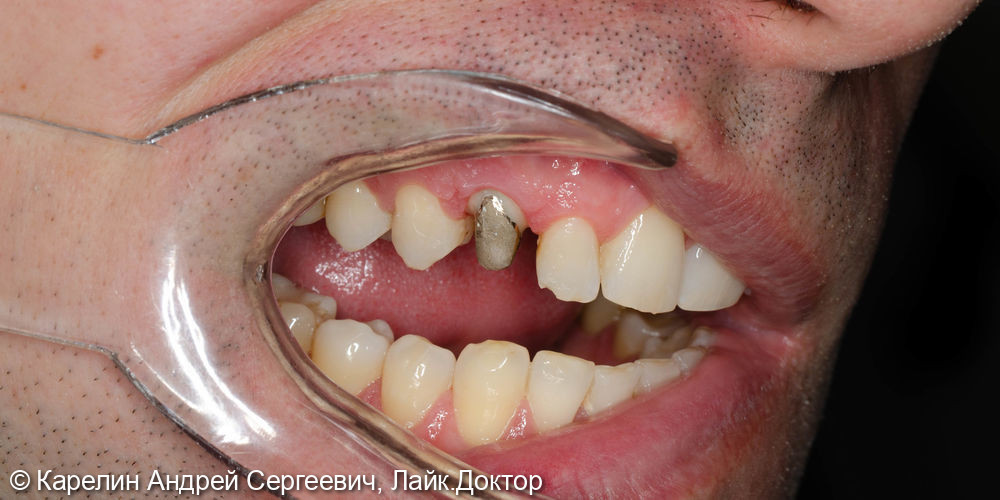 Восстановление травмированного зуба 1.3 с помощью культевой вкладки и коронки на основе диоксида циркония - фото №1