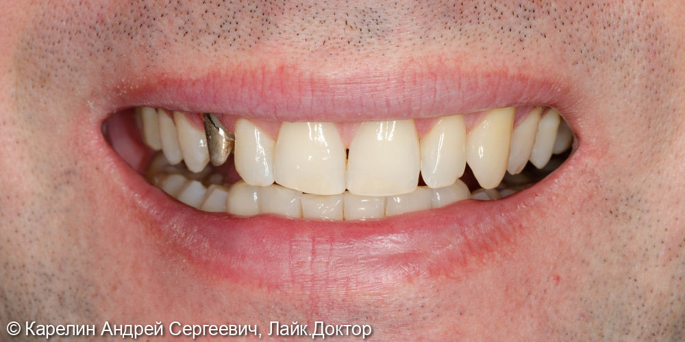 Восстановление травмированного зуба 1.3 с помощью культевой вкладки и коронки на основе диоксида циркония - фото №2