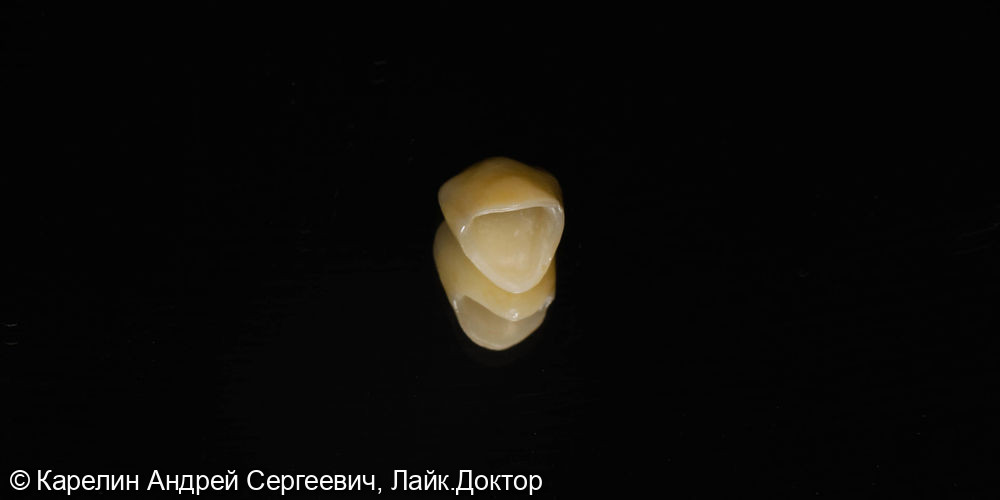 Восстановление травмированного зуба 1.3 с помощью культевой вкладки и коронки на основе диоксида циркония - фото №3