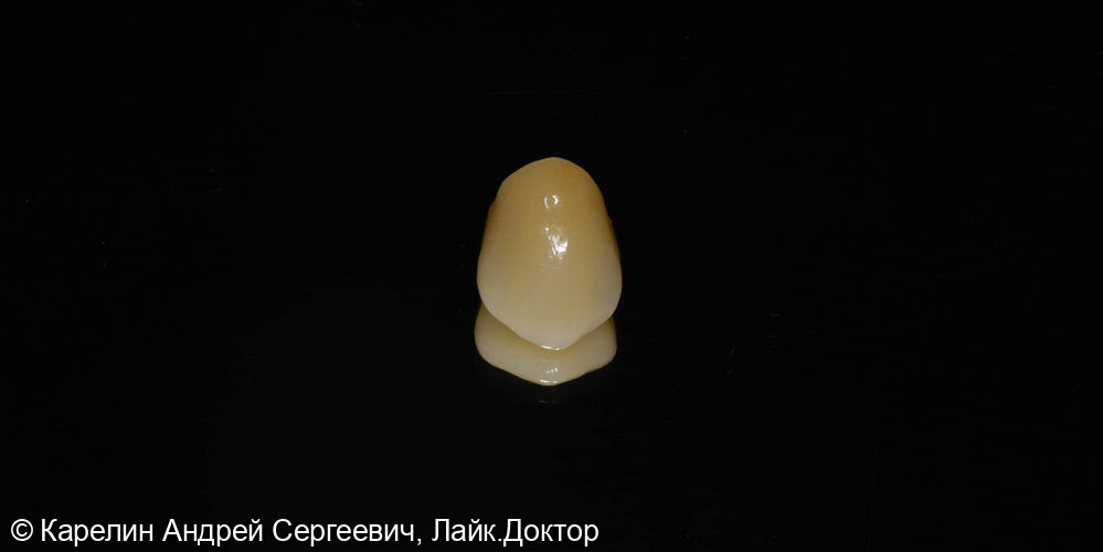 Восстановление травмированного зуба 1.3 с помощью культевой вкладки и коронки на основе диоксида циркония - фото №4