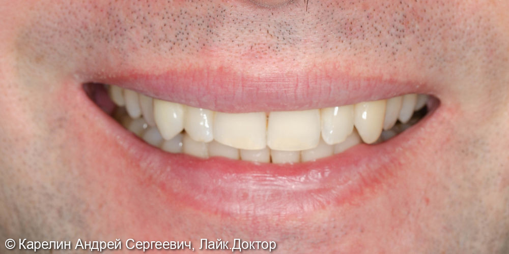 Восстановление травмированного зуба 1.3 с помощью культевой вкладки и коронки на основе диоксида циркония - фото №5