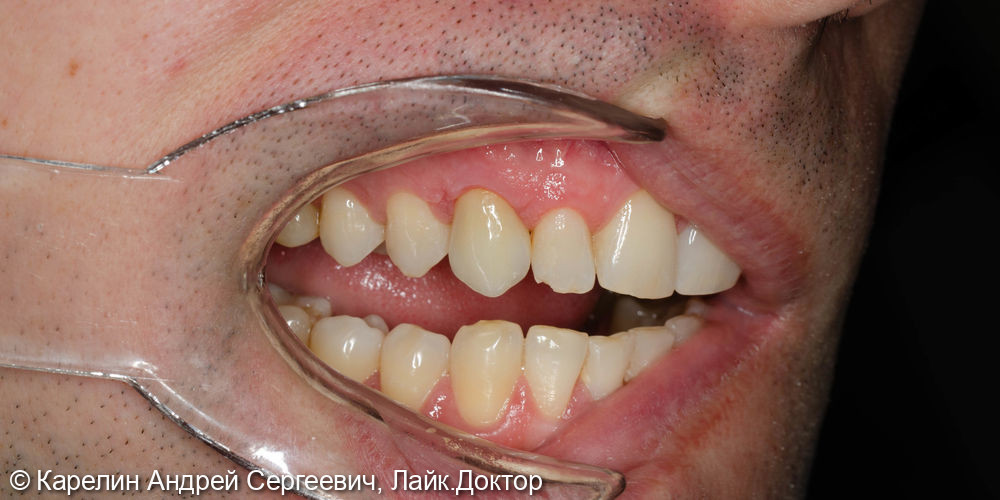 Восстановление травмированного зуба 1.3 с помощью культевой вкладки и коронки на основе диоксида циркония - фото №6