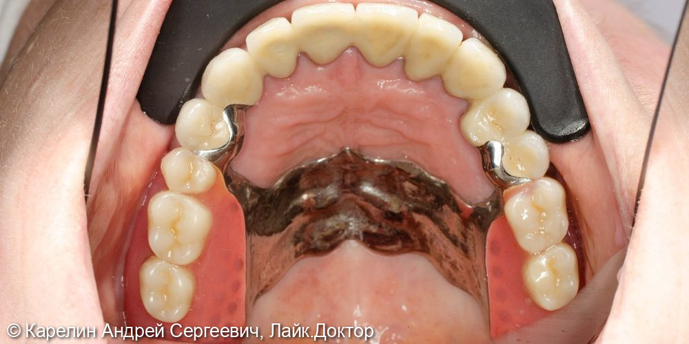 Протезирование обеих челюстей с помощью бюгельного протеза и металлокерамических коронок - фото №11