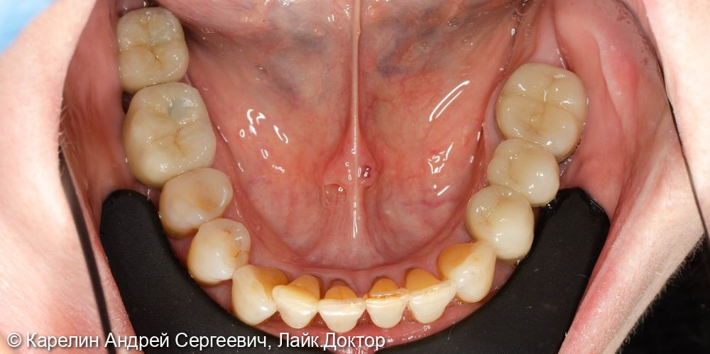 Протезирование обеих челюстей с помощью бюгельного протеза и металлокерамических коронок - фото №12