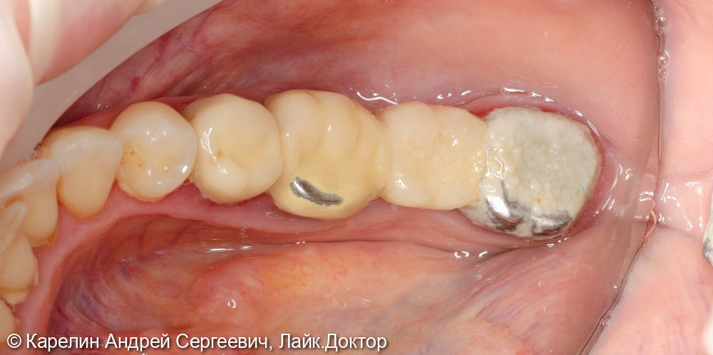 Удаление, костные пластики, имплантация и протезирование в области моляров верхней челюсти с - фото №1
