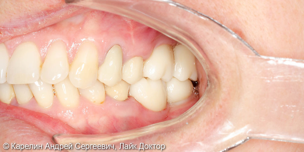 Удаление, костные пластики, имплантация и протезирование в области моляров верхней челюсти с - фото №25
