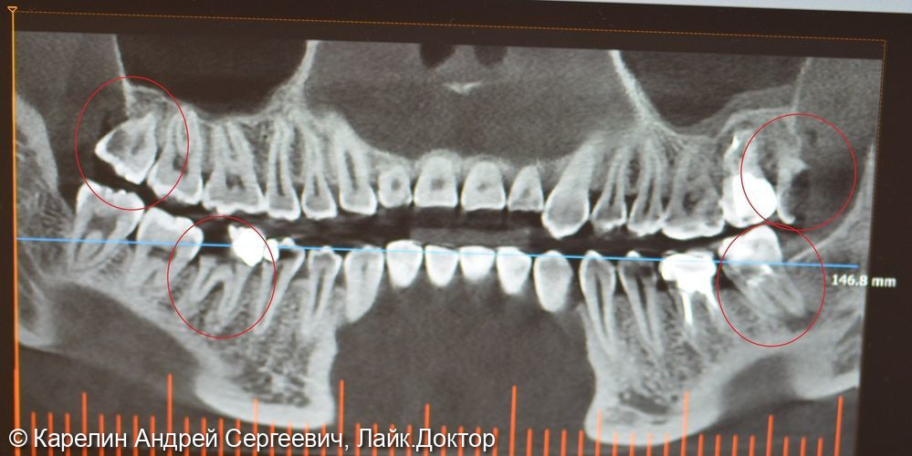 Удаление 4 зубов за один визит - фото №1