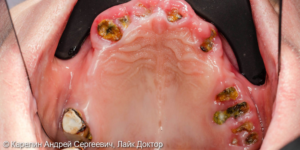 Тотальное протезирование с помощью бюгельных протезов с фиксацией на имплантаты и на зубы - фото №3