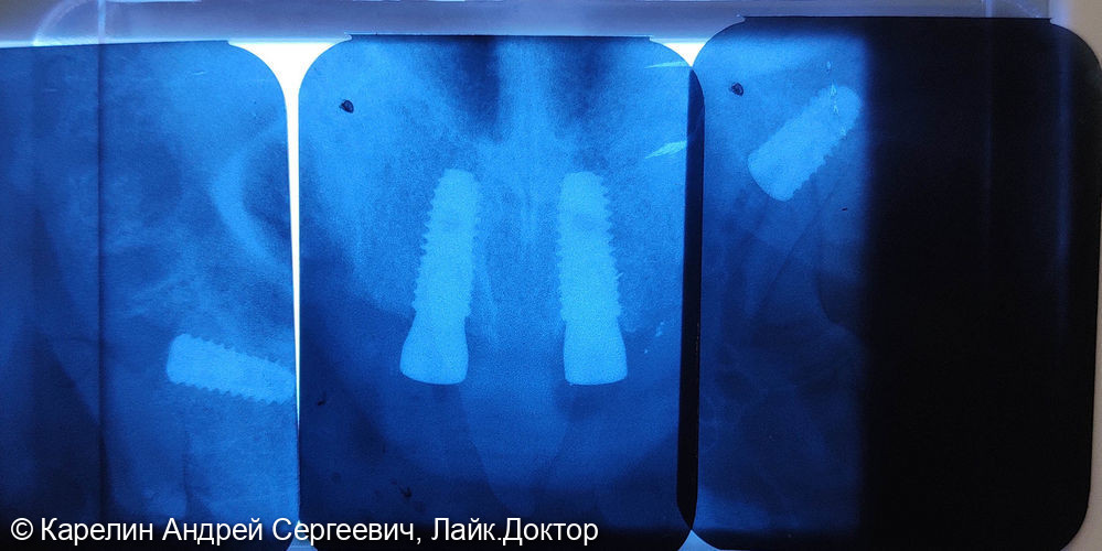 Тотальное протезирование с помощью бюгельных протезов с фиксацией на имплантаты и на зубы - фото №8