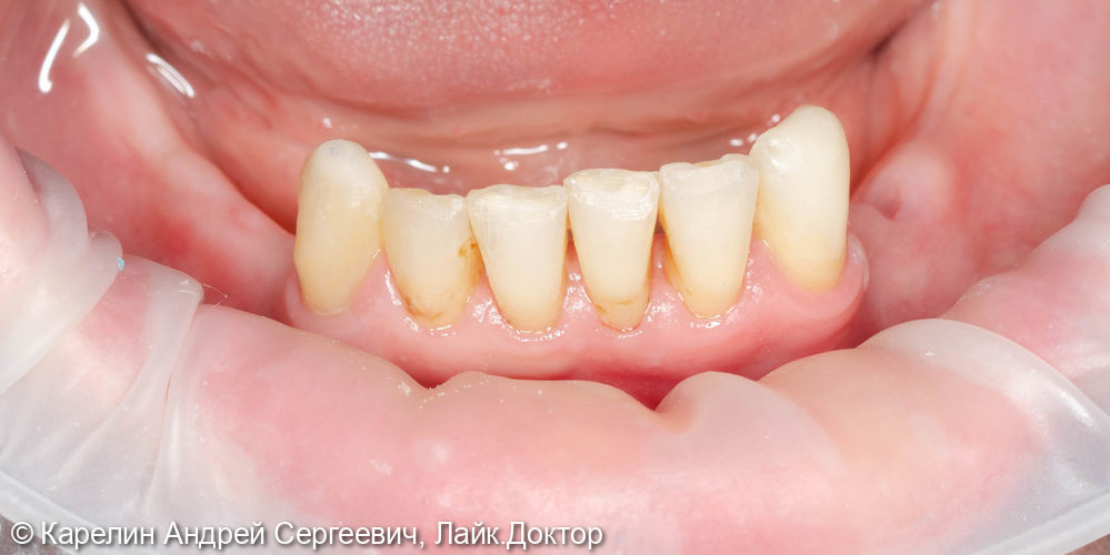 Тотальное протезирование с помощью бюгельных протезов с фиксацией на имплантаты и на зубы - фото №10
