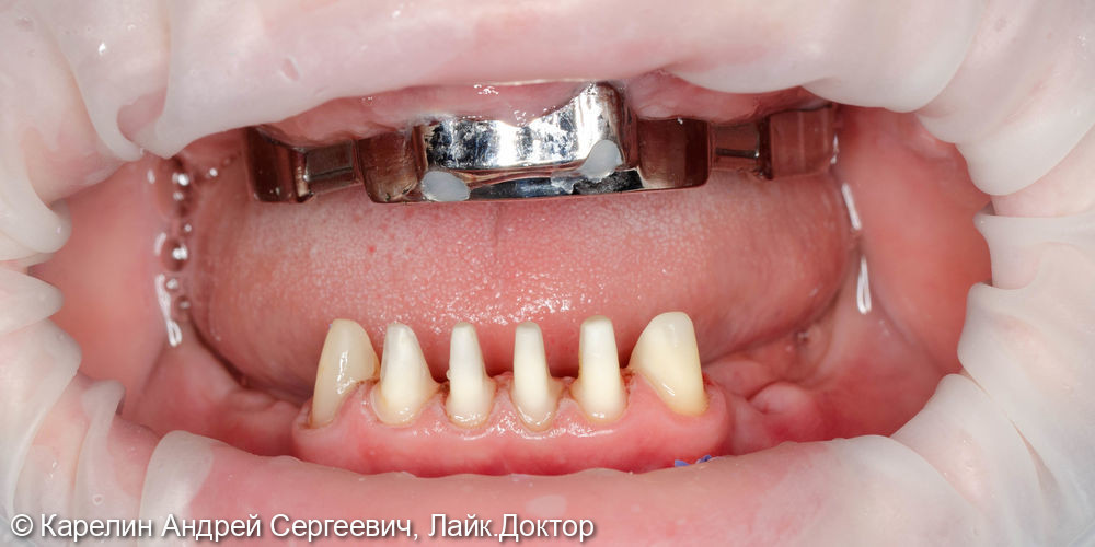 Тотальное протезирование с помощью бюгельных протезов с фиксацией на имплантаты и на зубы - фото №11