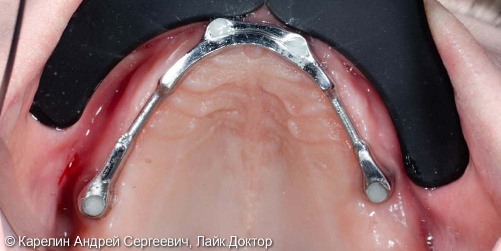 Тотальное протезирование с помощью бюгельных протезов с фиксацией на имплантаты и на зубы - фото №12