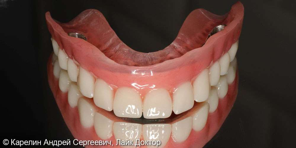 Тотальное протезирование с помощью бюгельных протезов с фиксацией на имплантаты и на зубы - фото №13