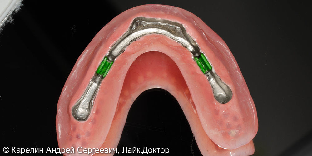 Тотальное протезирование с помощью бюгельных протезов с фиксацией на имплантаты и на зубы - фото №14