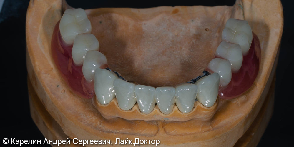 Тотальное протезирование с помощью бюгельных протезов с фиксацией на имплантаты и на зубы - фото №15