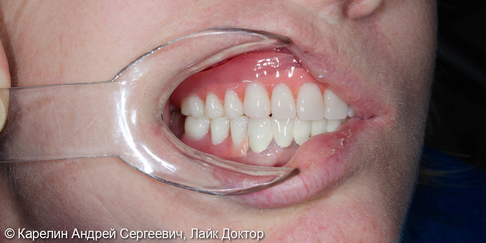 Тотальное протезирование с помощью бюгельных протезов с фиксацией на имплантаты и на зубы - фото №19