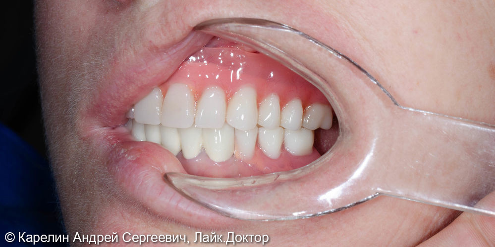 Тотальное протезирование с помощью бюгельных протезов с фиксацией на имплантаты и на зубы - фото №20