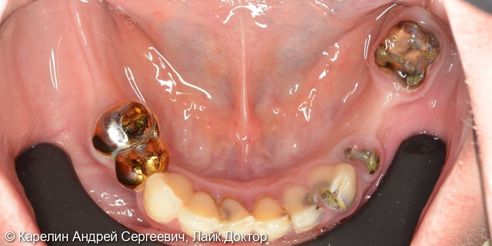Тотальное протезирование с помощью бюгельных протезов с фиксацией на имплантаты и на зубы - фото №4