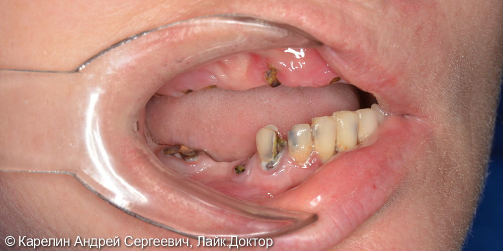 Тотальное протезирование с помощью бюгельных протезов с фиксацией на имплантаты и на зубы - фото №5