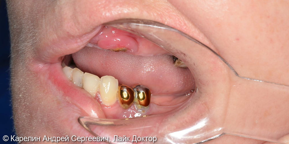Тотальное протезирование с помощью бюгельных протезов с фиксацией на имплантаты и на зубы - фото №6