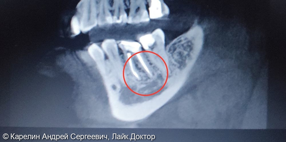 Лечение гранулёматозного периодонтита зуба 4.6 - фото №2
