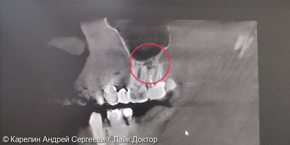 Лечение хронического периодонтита (кисты) зуба 2.6 - фото №1