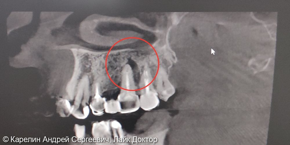 Лечение хронического периодонтита (кисты) зуба 2.6 - фото №2