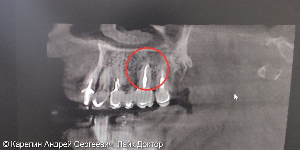 Лечение хронического периодонтита (кисты) зуба 2.6 - фото №3