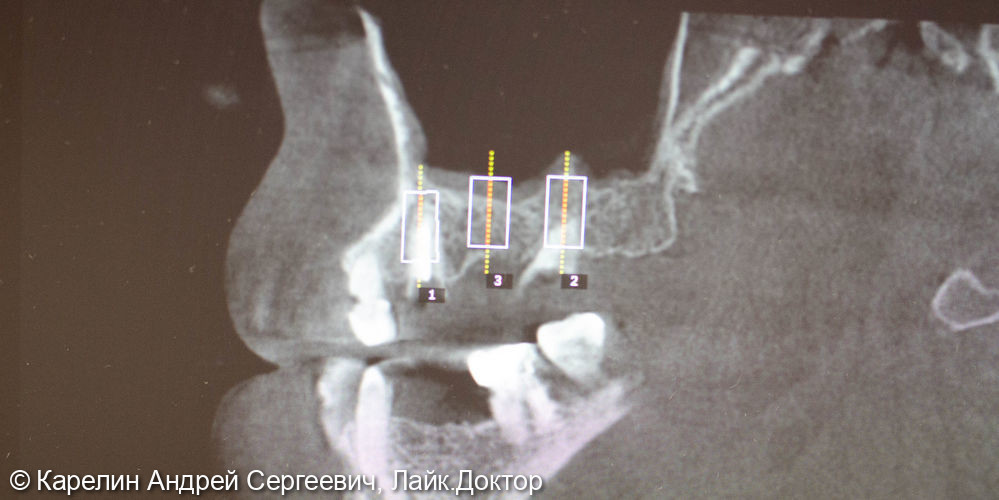 Тотальная реабилитация с помощью имплантатов и металлокерамических коронок - фото №6