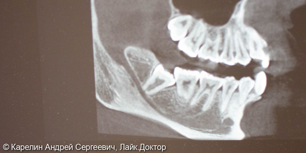 Удаление ретинированного зуба мудрости - фото №2