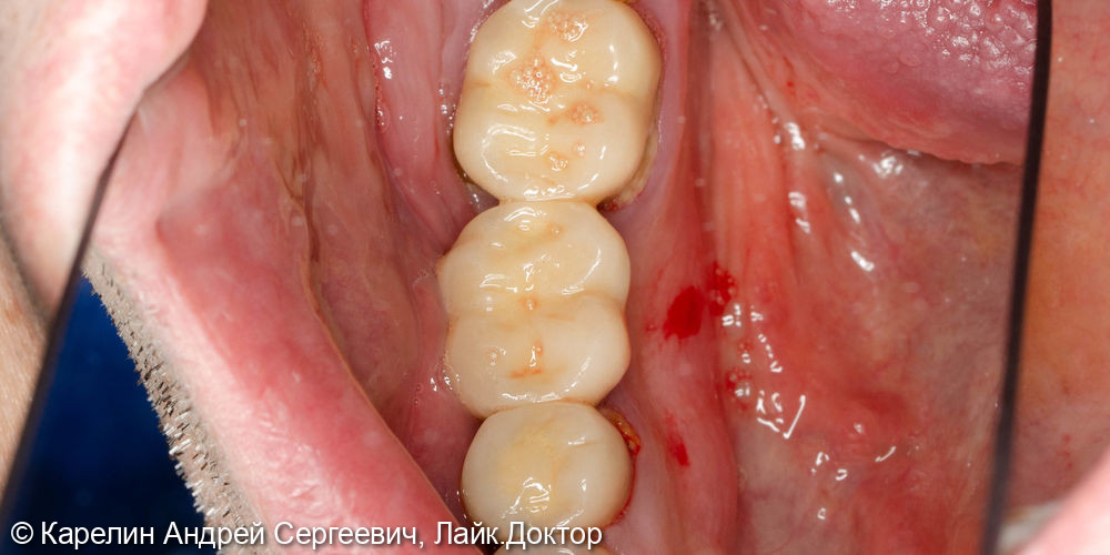 Установка 2 имплантатов одномоментно с удалением зуба - фото №1
