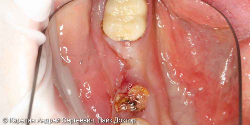 Установка 2 имплантатов одномоментно с удалением зуба - фото №2