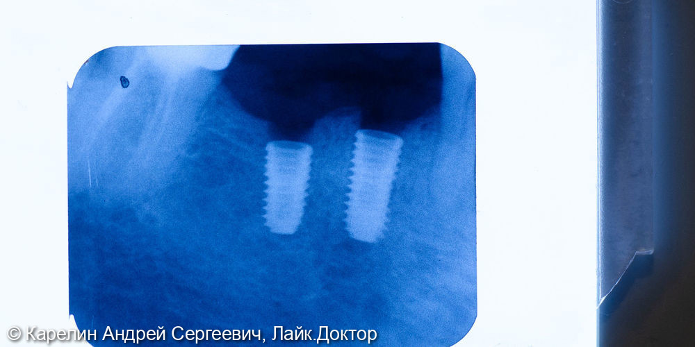 Установка 2 имплантатов одномоментно с удалением зуба - фото №4