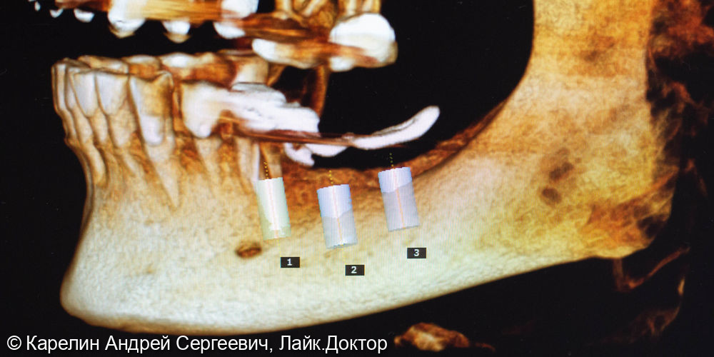 Замена съёмного протеза на имплантаты - фото №3