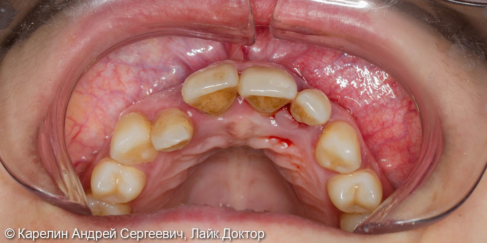 Эстетическая реабилитация на имплантатах пациентки с пародонтозом верхних резцов - фото №2