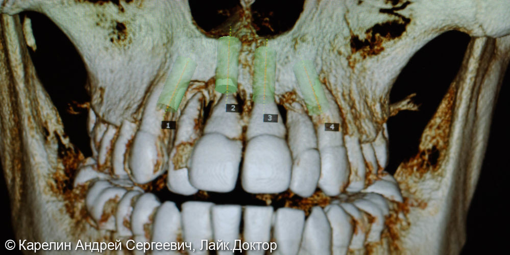 Эстетическая реабилитация на имплантатах пациентки с пародонтозом верхних резцов - фото №3
