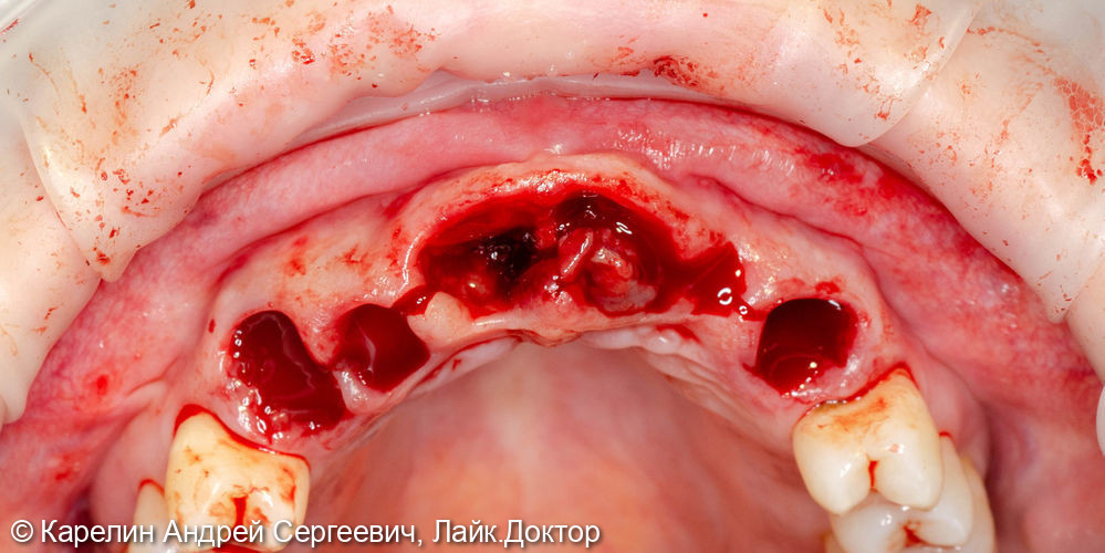 Эстетическая реабилитация на имплантатах пациентки с пародонтозом верхних резцов - фото №5